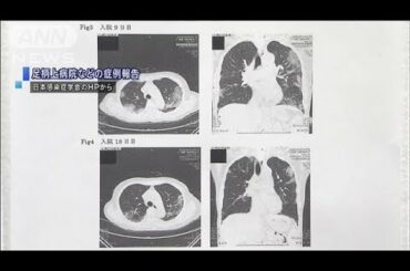 ぜんそく治療薬が効果か「感染者3人の症状改善」(20/03/03)