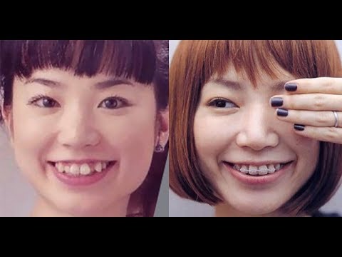 芸能人は歯が命 芸能人の歯並びの矯正before After 全然違う Yayafa